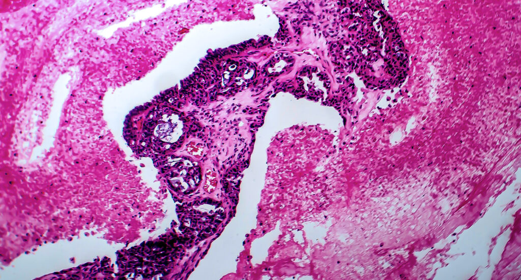 Papillary serous ovarian adenocarcinoma, cancer of ovary, light micrograph, photo under microscope